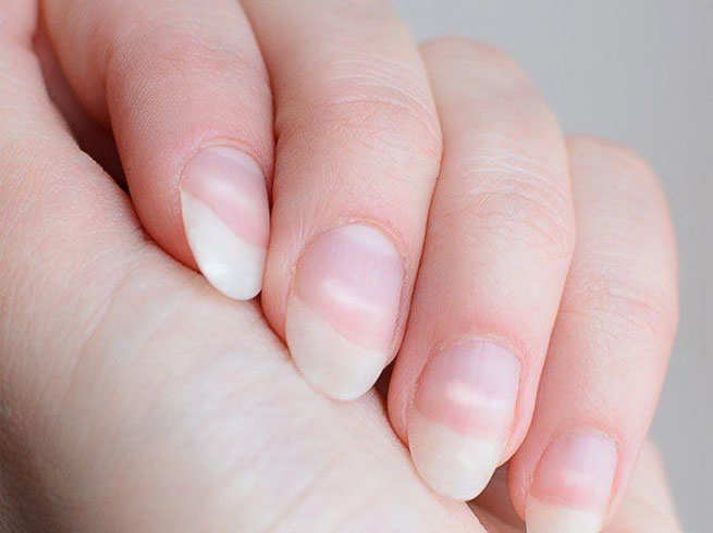 Nails के पास गड्ढें क्यों होते है । नाखून के गड्ढों का घरेलू इलाज । Pitted  Nails Remedies । Boldsky - YouTube